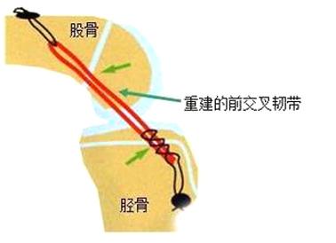 重塑骨骼健康，最新治骨方法与自信成就感的旅程