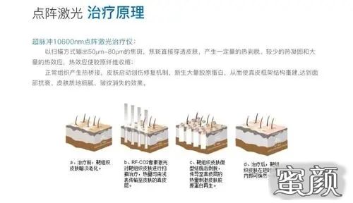 激光美容价格解析，你了解多少？