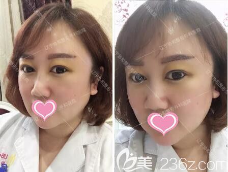 切眉术价格,切眉术价格，了解市场行情，选择最适合你的美容方案
